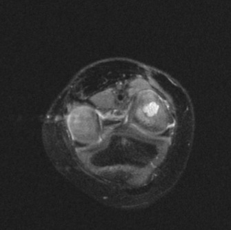 Figure 4 for case Staphylococcus osteomyelitis ( RID3715 )